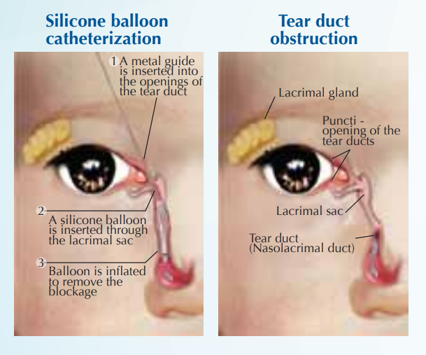 Хирургия врожденных закупорок слезных протоков